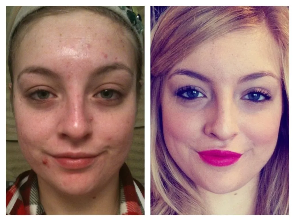 Roaccutane Yan Etkileri ve Kullanımı (Sivilce Hapı Roakutan)