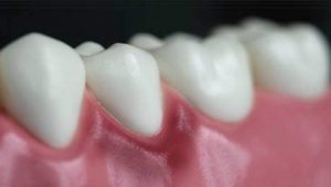 Diş Eti Çekilmesi Nasıl Tedavi Edilir?