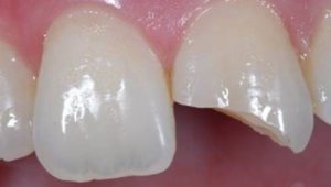 Kırılan Diş Nasıl Tedavi Edilir?